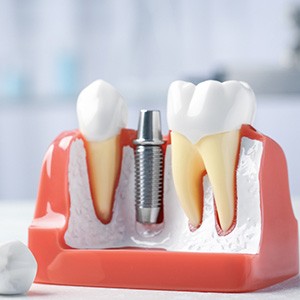 Model of dental implant on table