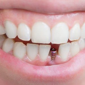 Close-up of dental implant in lower jaw