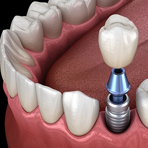 Illustration of dental crown being attached to a dental implant