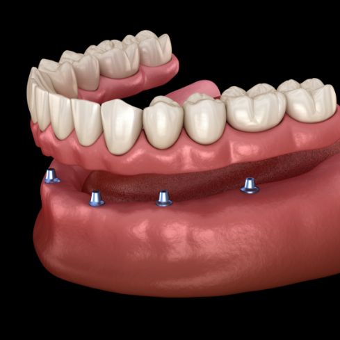Illustration of an All on 4 implant denture being placed in the lower arch