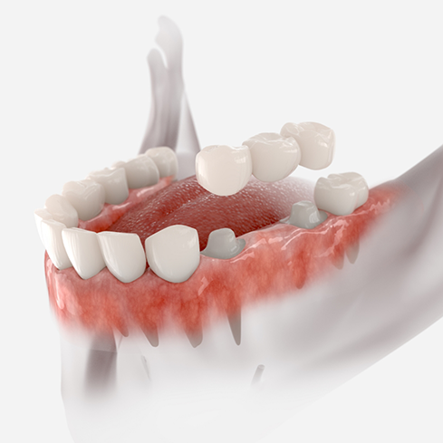 Illustration of a dental bridge being placed over two natural teeth to fill the gap between them