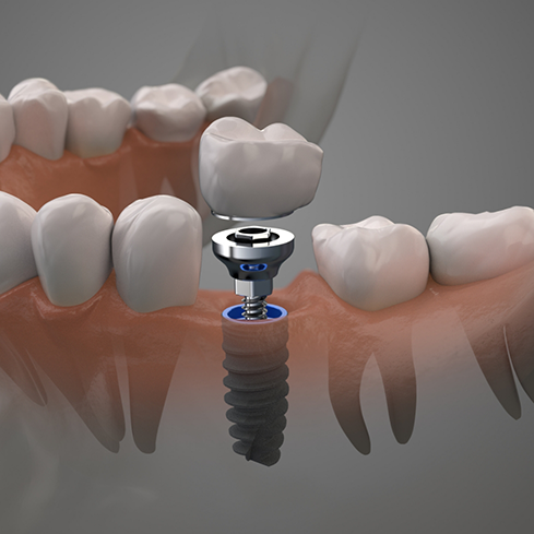 Illustration of a dental implant and a dental crown replacing a missing lower tooth
