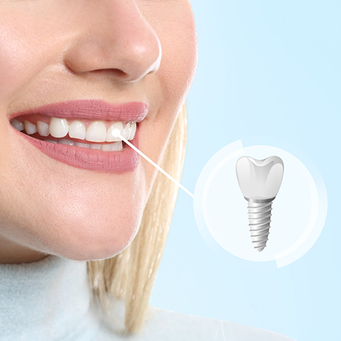 Close up of a woman with a dental implant smiling