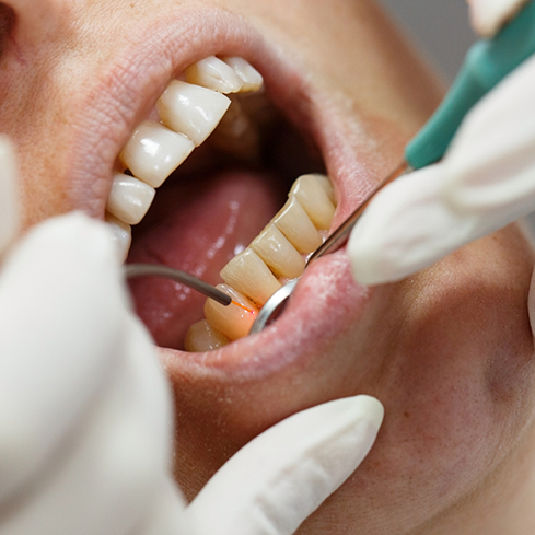 CLose up of a dental patient having their gums treated with a soft tissue laser