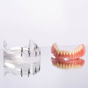 Clear base with several implants next to dentures on reflective surface