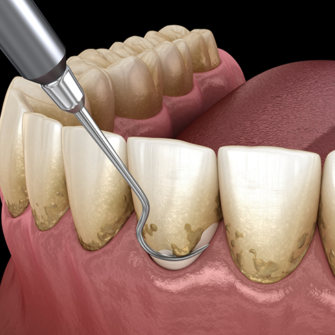 Illustration of a dental scaler removing tartar buildup from the gumline