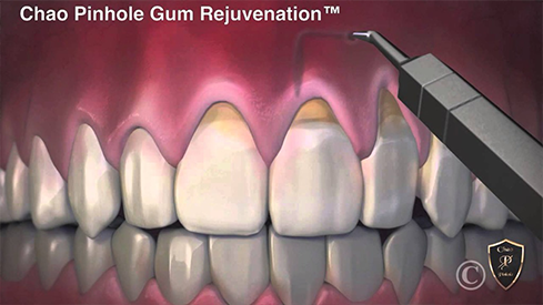 Illustration of a piece of pink tissue being grafted over a receding gumline