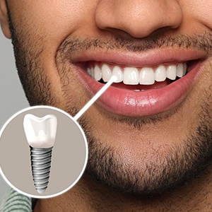 Nose-to-neck view of man smiling with one tooth indicated as an implant