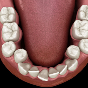 Illustration of crooked teeth