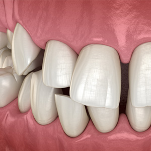 Illustration of gapped teeth