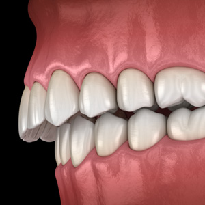 Illustration of an overbite