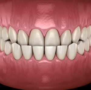 Illustration of an underbite