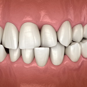 Illustration of a crossbite