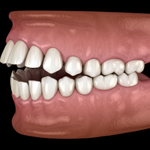 Illustration of an open bite