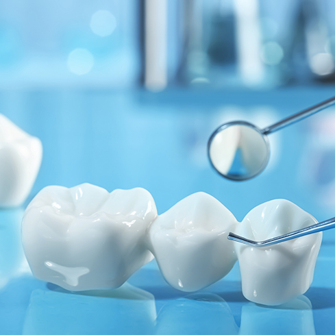 Three part dental bridge next to a dental mirror