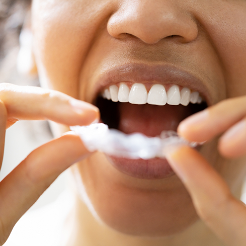 Person placing a clear nightguard tray over their teeth