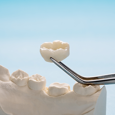 Tweezers holding a dental crown over a model of a row of teeth