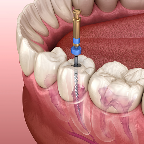 Illustration of a long thin dental instrument accessing and treating the innermost layer of a tooth