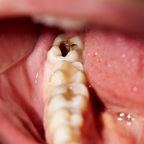 Close up of a mouth with a severely decayed and damaged tooth