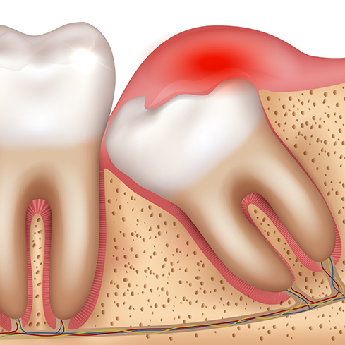 Illustration of a decayed and impacted wisdom tooth pressing against the adjacent tooth