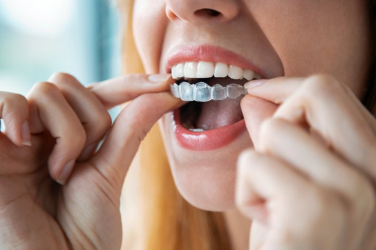 Woman removing her Invisalign aligners.