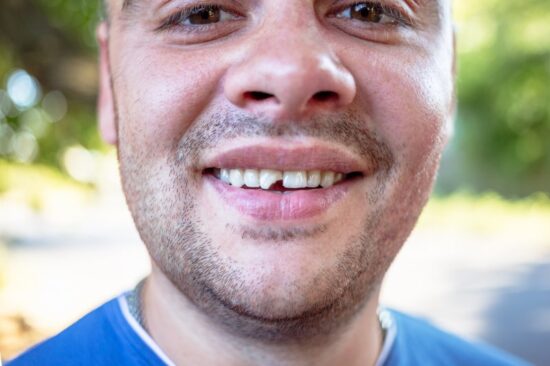 Man with front chipped tooth.