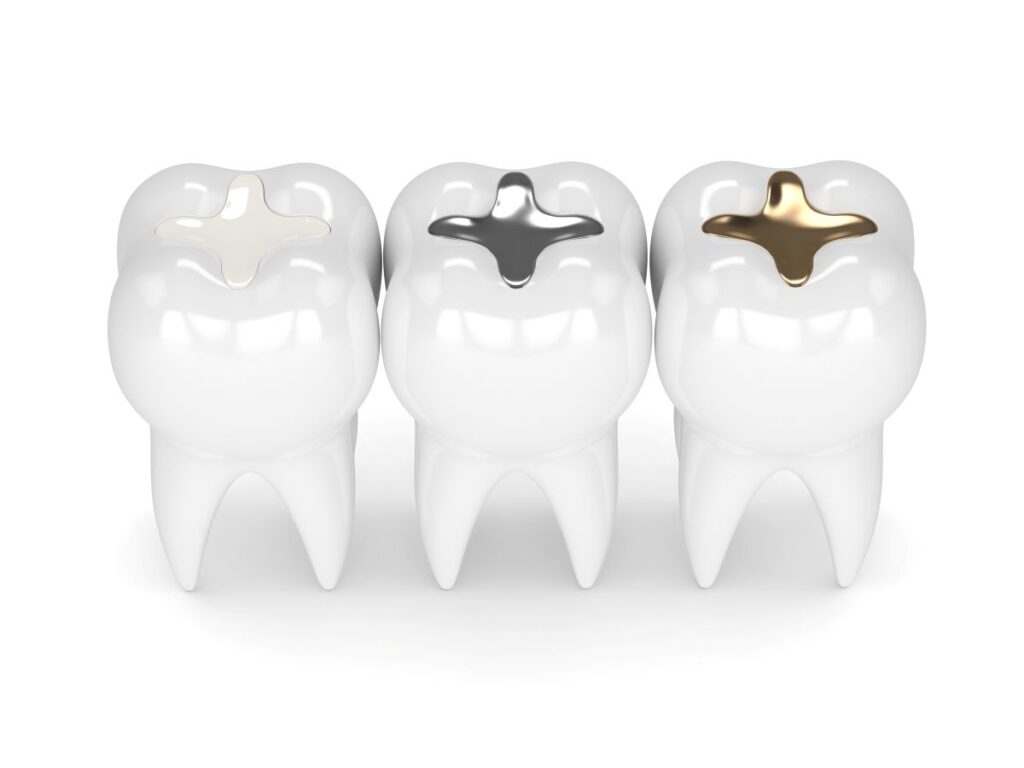 Tooth fillings in different colors