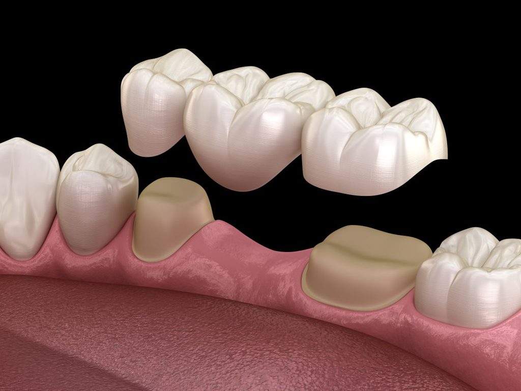 A CGI of a dental bridge fitting onto reshaped teeth